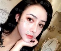 鼻整形前后变化有多大？3位美女真实蜕变 width=