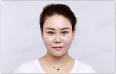 她做了面部埋线-提升，竟然还有瘦脸果？！ width=