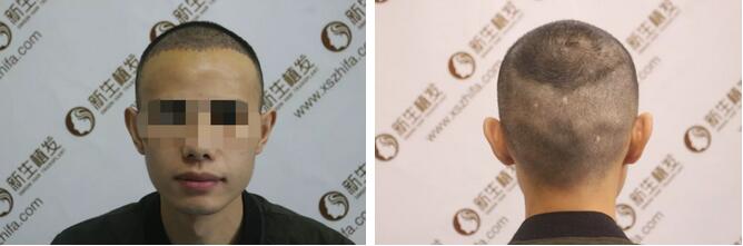 【发际线种植成功后，还会掉落吗？这篇日记讲得明明白白的！】