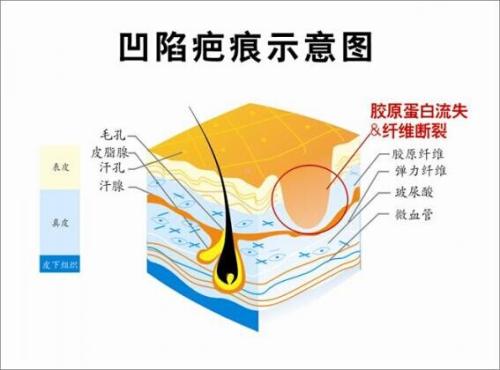 祛疤的三种方法，正确选择避免做无用功