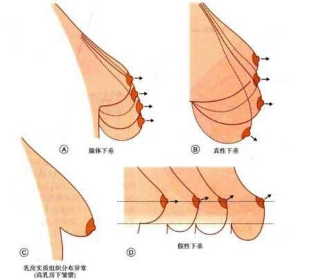 乳房下垂矫正避免出现感情危机