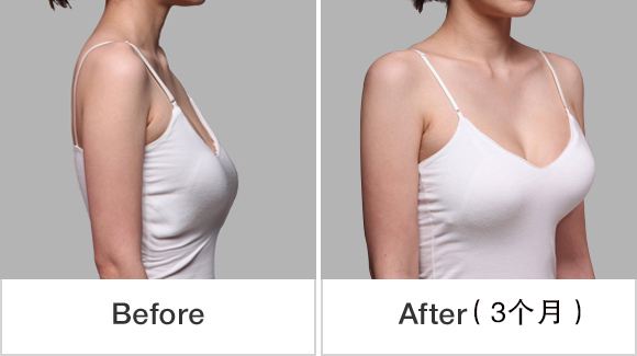 乳房下垂矫正避免出现感情危机