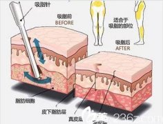 吸脂减肥手术大概多少钱? width=