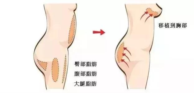 北京自体脂肪丰胸手术 造就迷人双峰