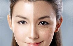 亳州祛斑多少钱？去哪家医院好​？ width=