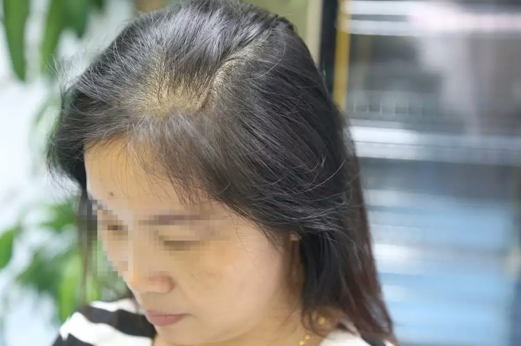 TDDP种植3000单位，新生许她岁月不老，芳华自在！