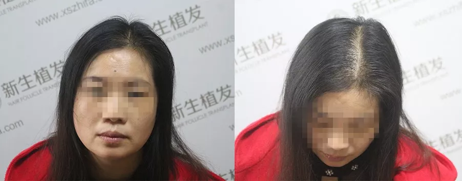 TDDP种植3000单位，新生许她岁月不老，芳华自在！