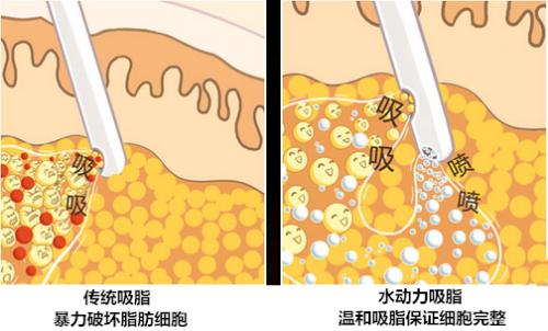 大腿吸脂，控制饮食还是很重要的