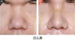 蒜头鼻整形大概要好多钱哎？这个问题困扰了我很久呢！ width=