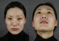 注射瘦脸打几次能定型喃？跟我看个案例大概了解一哈看！ width=