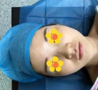 硅胶隆鼻有后遗症迈？下面这篇案例会给你讲明很多道理！ width=