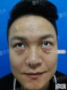 29岁小伙眼袋比大叔还严重，20分钟后果惊呆女友！ width=