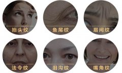 射频除皱是什么?除皱果好吗? width=