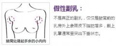 副乳切除切口开在什么地方?明X吗? width=
