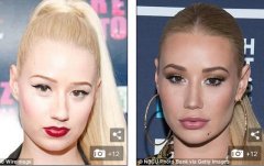Iggy Azalea通过垫下巴和下颌角整形改变了她的脸，格外引人注目！