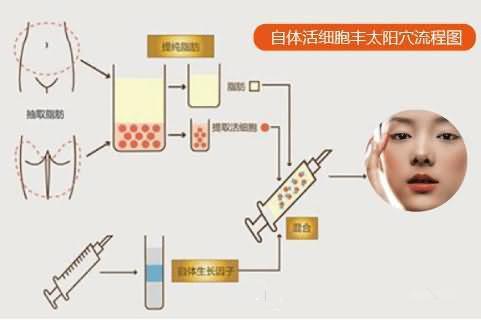 自体脂肪丰太阳穴可以保持多久?