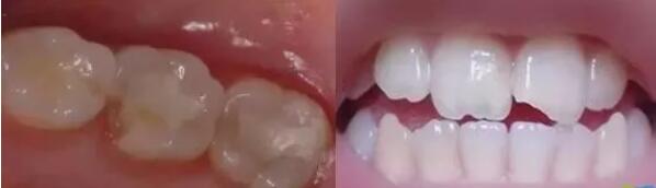 【牙齿崩掉了一小块，是缺乏什么元素营养吗？】