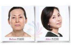 打完注射除皱后眼睛会不会变小? width=