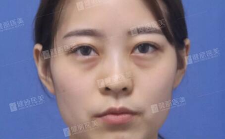 【溶脂去眼袋果很不错？溶脂去眼袋案例告诉你！】