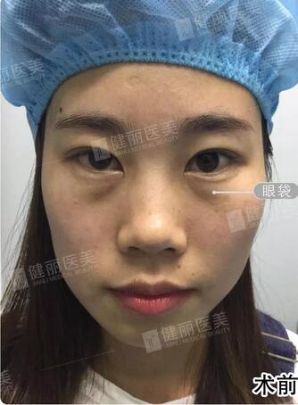 【溶脂去眼袋果很不错？溶脂去眼袋案例告诉你！】