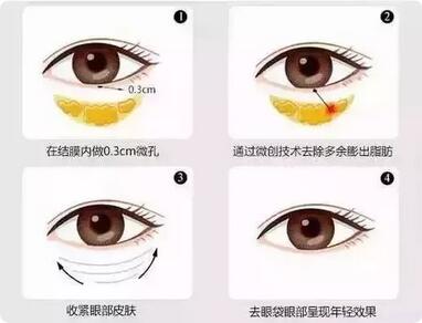 【溶脂去眼袋果很不错？溶脂去眼袋案例告诉你！】