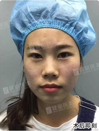 【溶脂去眼袋果很不错？溶脂去眼袋案例告诉你！】