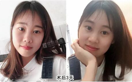 【溶脂去眼袋果很不错？溶脂去眼袋案例告诉你！】
