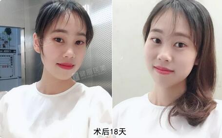 【溶脂去眼袋果很不错？溶脂去眼袋案例告诉你！】