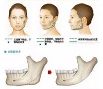 下颌角磨削多少钱?果好吗? width=