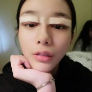 温志刚整形好不好?我的生物焊接双眼皮恢复经历对比图 width=
