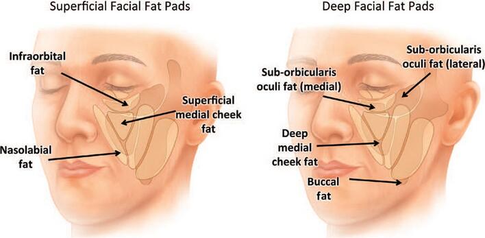 去颊脂垫的危害