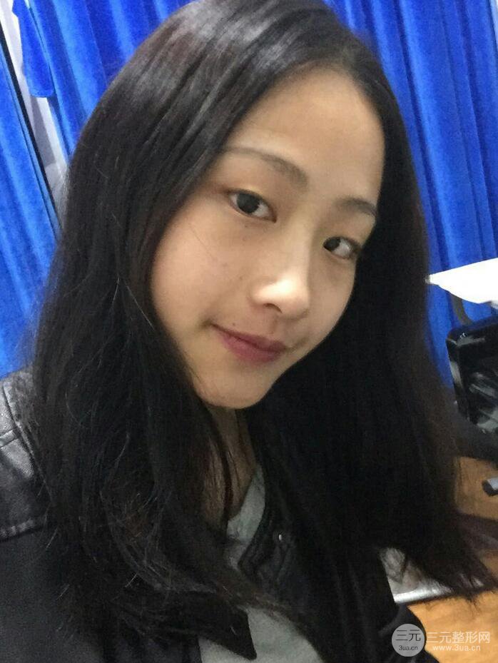 广州紫馨曹仁昌双眼皮案例，见证曹仁昌医生的厉害之处！