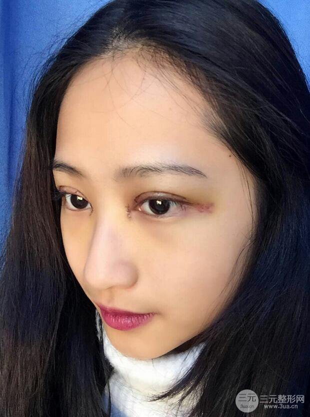 广州紫馨曹仁昌双眼皮案例，见证曹仁昌医生的厉害之处！