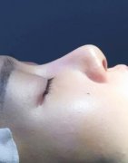 屈琳整形医生关于他的隆鼻手术案列分享给需要的朋友 width=