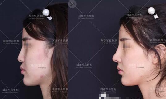 刘彦军鼻修复案例
