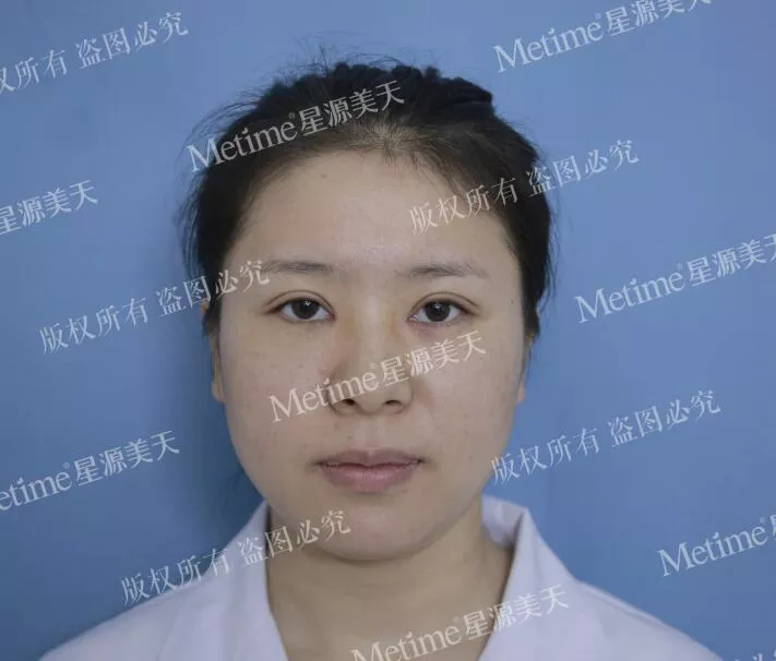开眼角前后对比图片