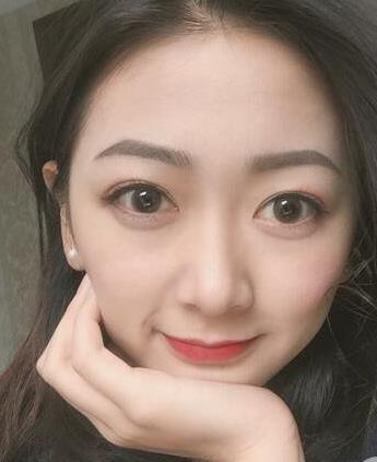 卢相勋双眼皮案例硬核分享，来瞅瞅~ width=