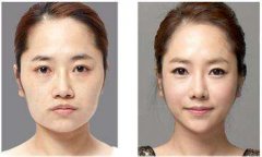 磨腮削骨多少钱?不用再羡慕V字脸的女人 width=