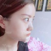 美人沟下巴90后妹纸的真实恢复对比，果好惨了!! width=