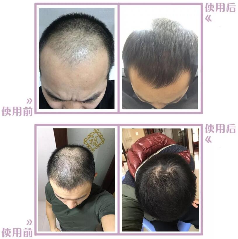 FUT植发