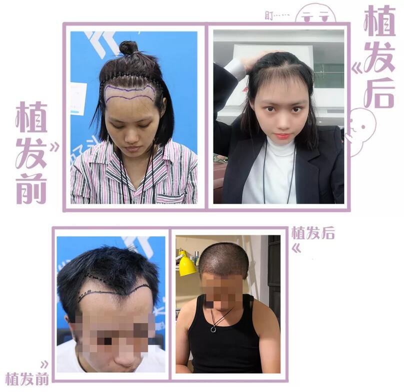 FUT植发