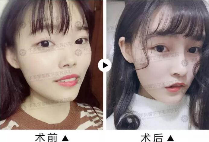 注射隆鼻前后对比图——鼻子漂亮鼻头也要！