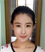 打注射瘦脸前后果图，真实经历分享 width=