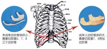 外耳再造要用多少肋软骨？外耳再造~