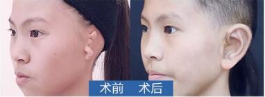 外耳再造果图