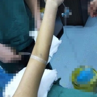 联合丽格整形医院可靠吗?******手臂吸脂案例及前后对比图与大家分享