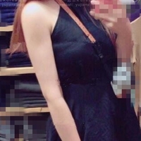 联合丽格整形医院可靠吗?******手臂吸脂案例及前后对比图与大家分享