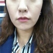 光波拉皮有果吗?光波拉皮恢复过程展示，附前后对比图 width=