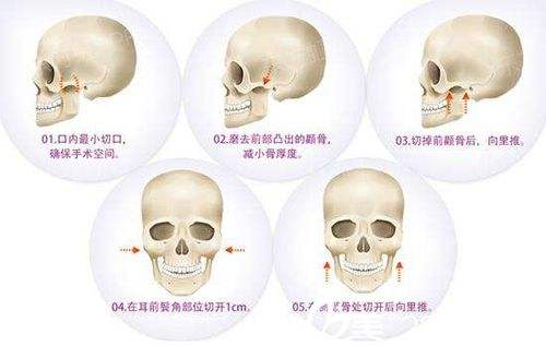 削骨要多少钱?北京张笑天自身经验为你解答