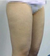 大腿溶脂术让矮短腿的我瞬间变成苗条大长腿 width=